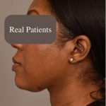 Neck Liposuction / Chin Liposuction Before & After Patient #1747