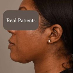 Neck Liposuction / Chin Liposuction Before & After Patient #1747
