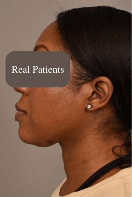 Neck Liposuction / Chin Liposuction Before & After Patient #1747