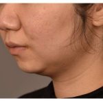 Neck Liposuction / Chin Liposuction Before & After Patient #1750