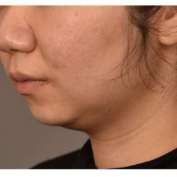Neck Liposuction / Chin Liposuction Before & After Patient #1750