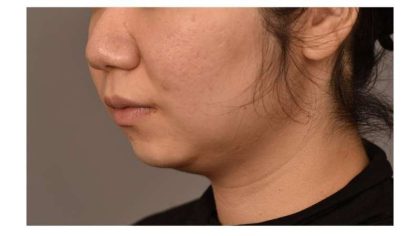 Neck Liposuction / Chin Liposuction Before & After Patient #1750