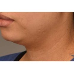 Neck Liposuction / Chin Liposuction Before & After Patient #1753