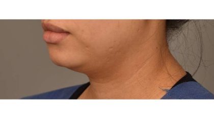 Neck Liposuction / Chin Liposuction Before & After Patient #1753