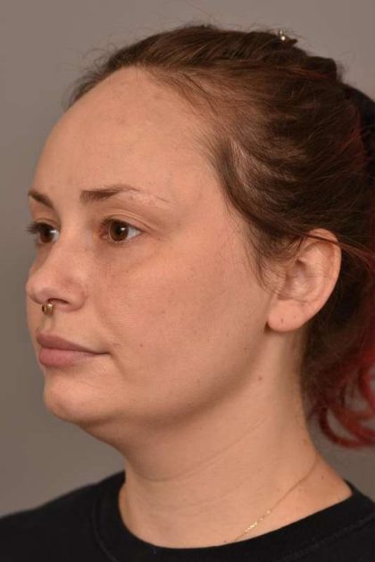 Neck Liposuction / Chin Liposuction Before & After Patient #1756
