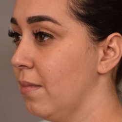 Neck Liposuction / Chin Liposuction Before & After Patient #1761