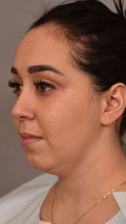 Neck Liposuction / Chin Liposuction Before & After Patient #1761