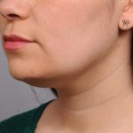 Neck Liposuction / Chin Liposuction Before & After Patient #1770
