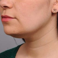 Neck Liposuction / Chin Liposuction Before & After Patient #1770