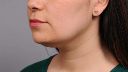 Neck Liposuction / Chin Liposuction Before & After Patient #1770