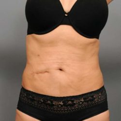 Tummy Tuck Before & After Patient #377