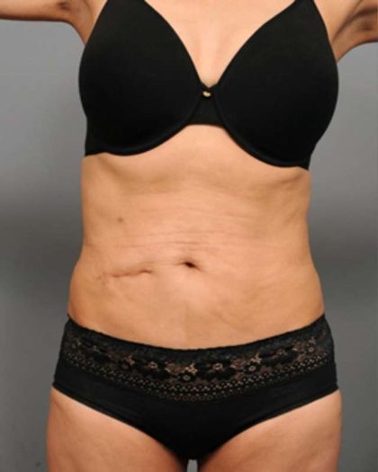 Tummy Tuck Before & After Patient #377