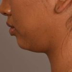 Neck Liposuction / Chin Liposuction Before & After Patient #1787