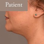 Neck Liposuction / Chin Liposuction Before & After Patient #1794