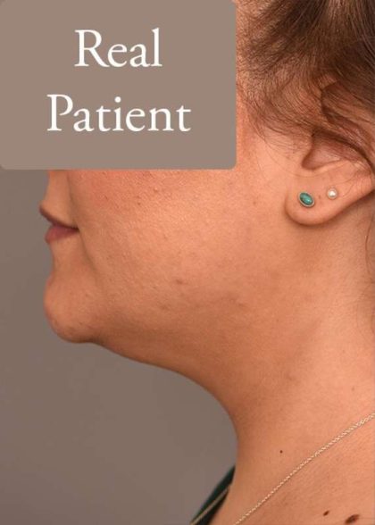 Neck Liposuction / Chin Liposuction Before & After Patient #1794