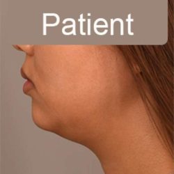 Neck Liposuction / Chin Liposuction Before & After Patient #1801