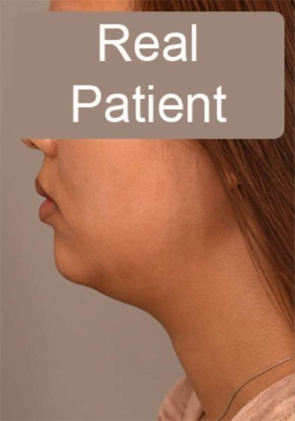 Neck Liposuction / Chin Liposuction Before & After Patient #1801