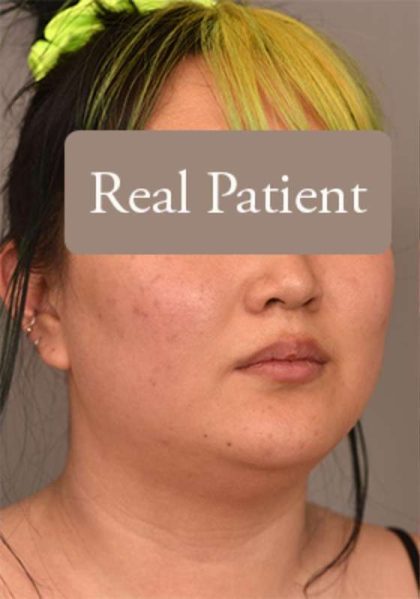 Neck Liposuction / Chin Liposuction Before & After Patient #1816