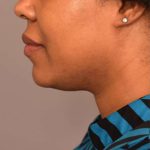 Neck Liposuction / Chin Liposuction Before & After Patient #1824