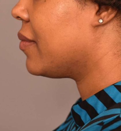 Neck Liposuction / Chin Liposuction Before & After Patient #1824