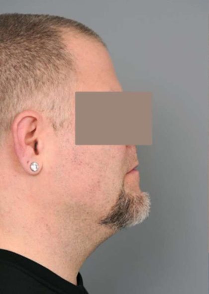 Neck Liposuction / Chin Liposuction Before & After Patient #1831