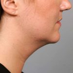 Neck Liposuction / Chin Liposuction Before & After Patient #1839