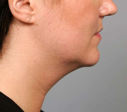 Neck Liposuction / Chin Liposuction Before & After Patient #1839