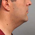 Neck Liposuction / Chin Liposuction Before & After Patient #1846