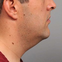 Neck Liposuction / Chin Liposuction Before & After Patient #1846