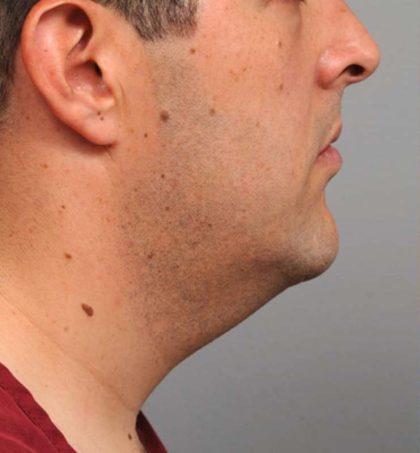 Neck Liposuction / Chin Liposuction Before & After Patient #1846
