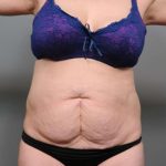 Tummy Tuck Before & After Patient #386