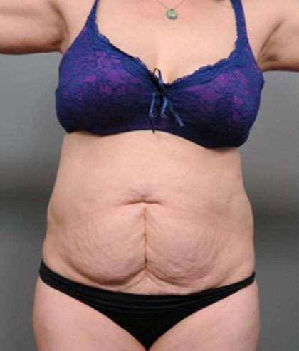Tummy Tuck Before & After Patient #386