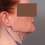 Neck Liposuction / Chin Liposuction Before & After Patient #1854