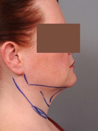 Neck Liposuction / Chin Liposuction Before & After Patient #1854