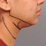 Neck Liposuction / Chin Liposuction Before & After Patient #1859