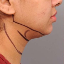 Neck Liposuction / Chin Liposuction Before & After Patient #1859
