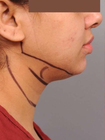 Neck Liposuction / Chin Liposuction Before & After Patient #1859