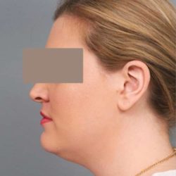 Neck Liposuction / Chin Liposuction Before & After Patient #1864