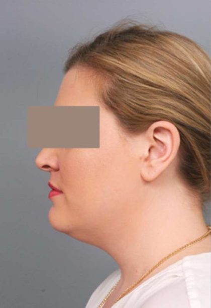 Neck Liposuction / Chin Liposuction Before & After Patient #1864
