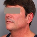 Neck Liposuction / Chin Liposuction Before & After Patient #1877