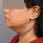 Neck Liposuction / Chin Liposuction Before & After Patient #1893