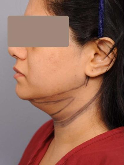 Neck Liposuction / Chin Liposuction Before & After Patient #1893