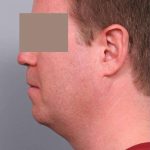 Neck Liposuction / Chin Liposuction Before & After Patient #1900