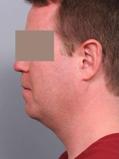 Neck Liposuction / Chin Liposuction Before & After Patient #1900
