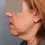 Neck Liposuction / Chin Liposuction Before & After Patient #1905