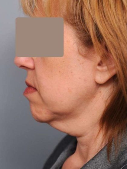 Neck Liposuction / Chin Liposuction Before & After Patient #1905