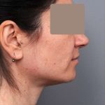 Neck Liposuction / Chin Liposuction Before & After Patient #1913