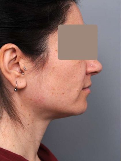 Neck Liposuction / Chin Liposuction Before & After Patient #1913