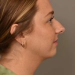 Neck Liposuction / Chin Liposuction Before & After Patient #1923
