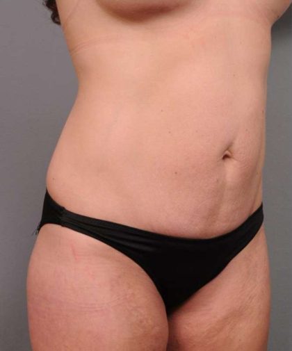 Tummy Tuck Before & After Patient #395